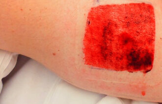 Sår dagen etter operasjon