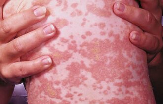 Bildet viser et barn med meslinger