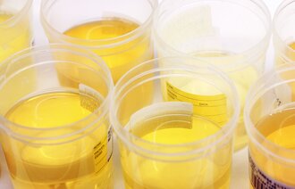 Bildet viser flere prøveglass med urin.